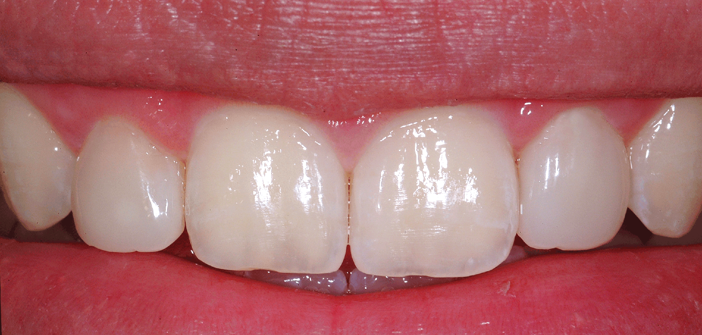 Closing the Gap in Direct Dentistry Treating Black Triangles Optident